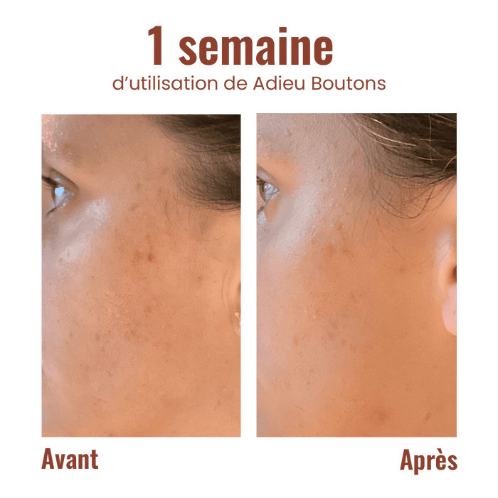 Goodbye pimples - Roll-on against blemishes