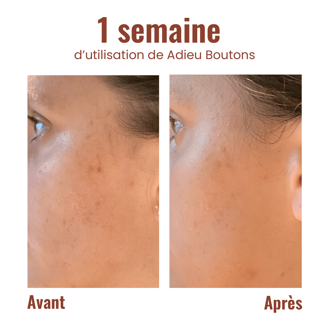 Goodbye pimples - Roll-on against blemishes