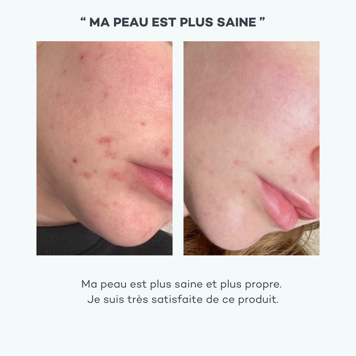 zinc peau