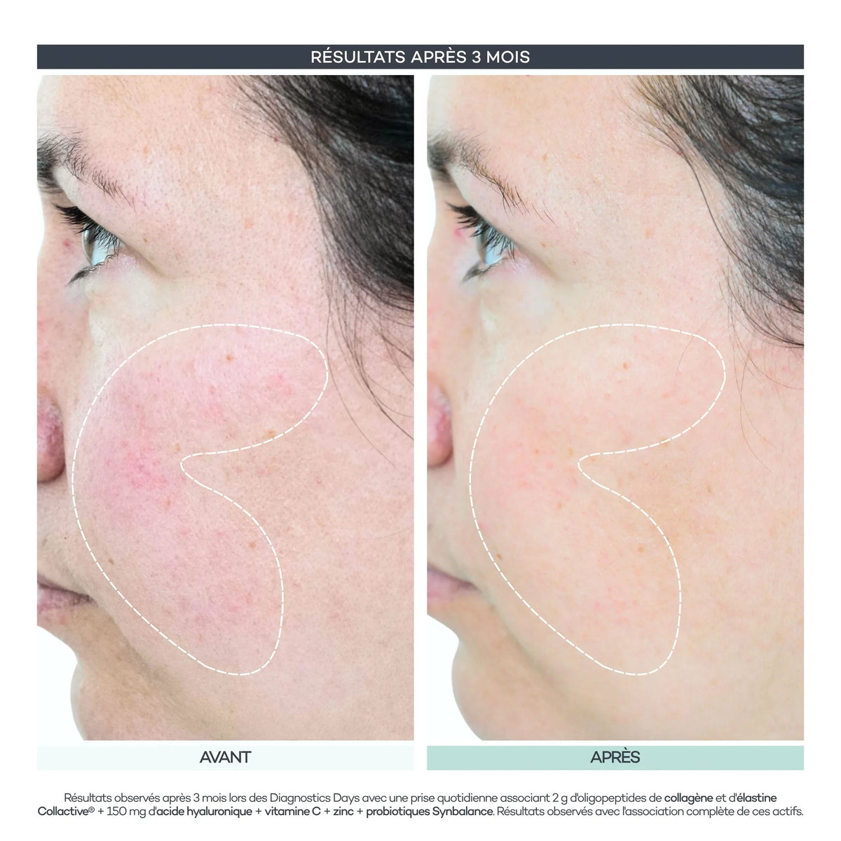 Avant / après 3 mois, rougeurs du visage de profil. Résultats observés lors des Diagnostics Days D-LAB