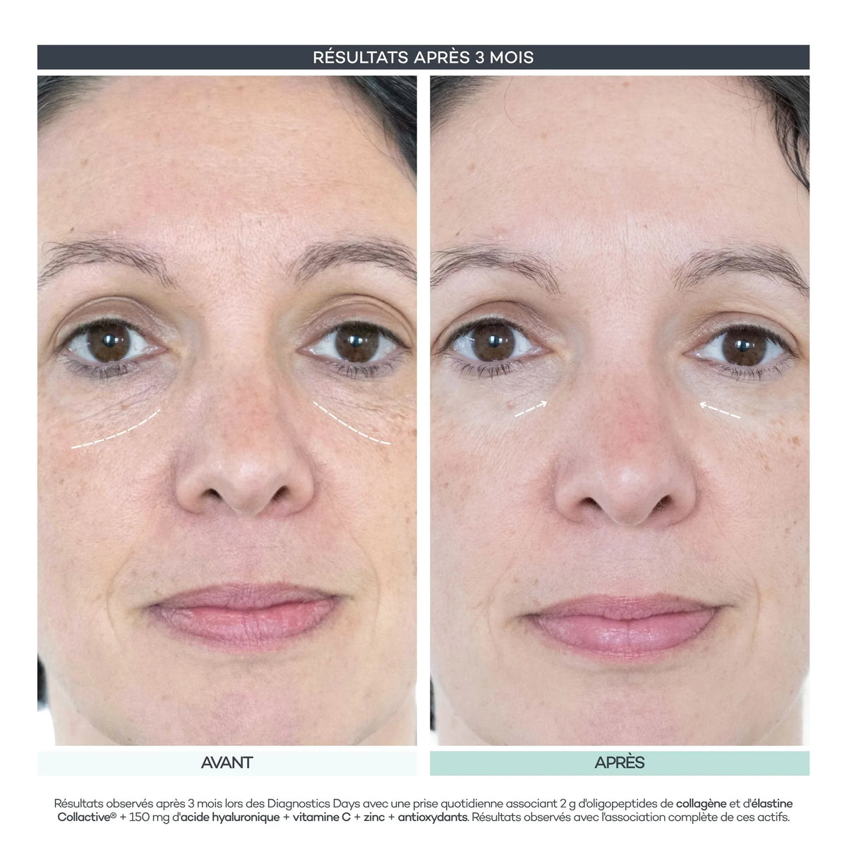 Avant / après 3 mois, visage de face : rides et teint. Résultats observés lors des Diagnostics Days D-LAB